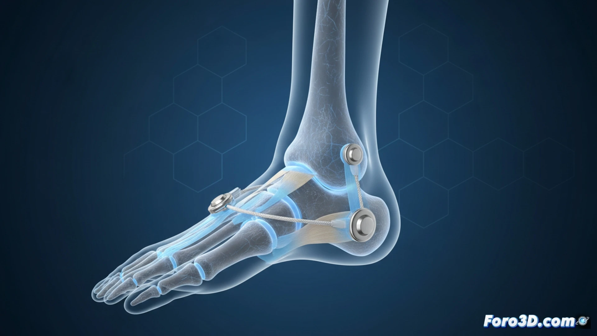 Descripción: Implante metálico SportLinc en tobillo humano, con fondo quirúrgico y luz azul, destacando la aprobación FDA para esguinces altos.