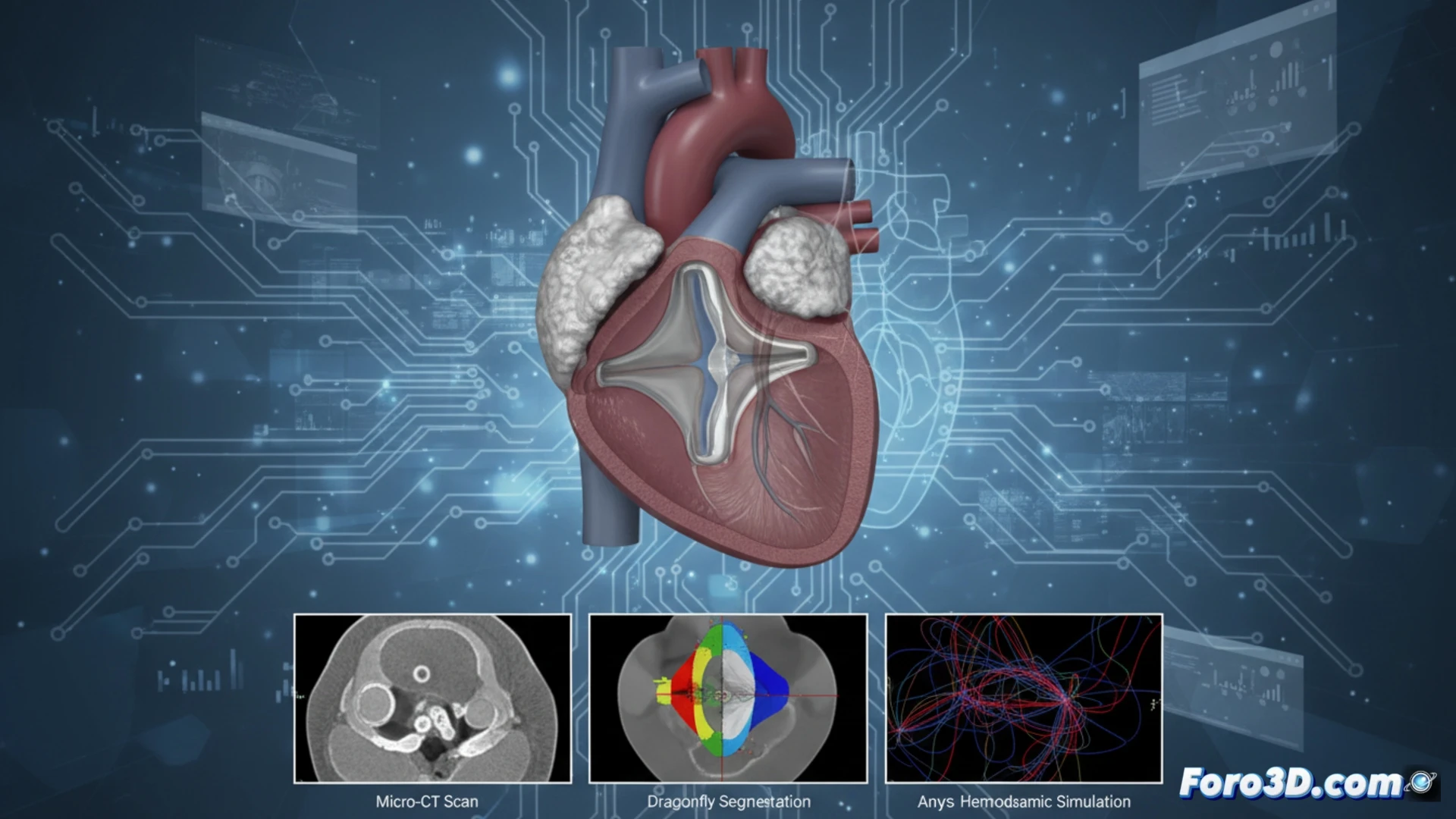 Micro-CT de válvula cardíaca bioprotésica revela calcificación asimétrica por error de plegado quirúrgico