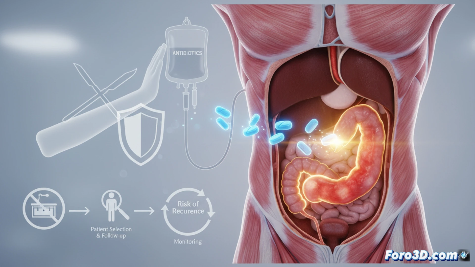 Paciente con apendicitis recibe antibióticos, mostrando una alternativa a la cirugía.
