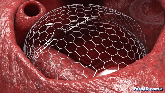 Fatiga de bajo ciclo en stent mitral: fractura por expansión incompleta