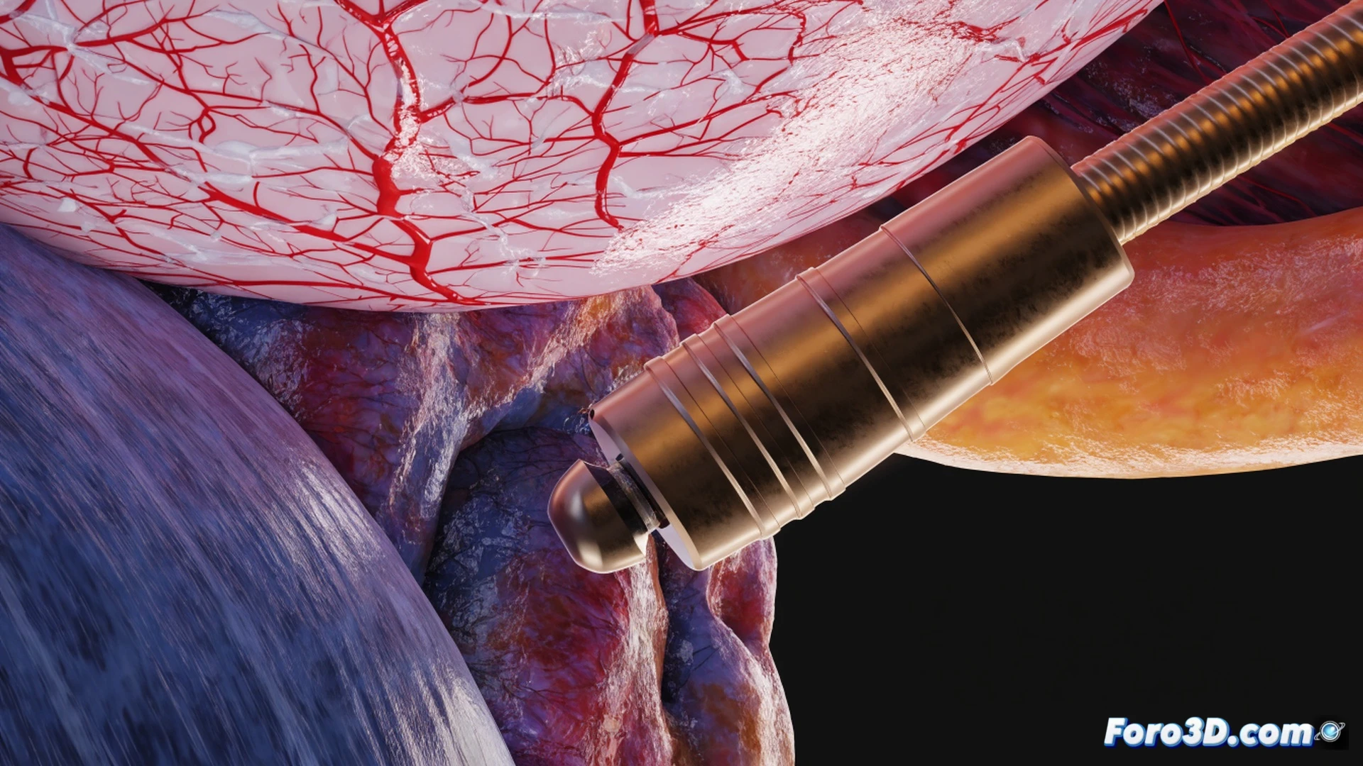 3D engineering visualization of cardiac ablation catheter tip penetrating myocardial tissue, off-center electrode tip deviating from ideal path, concentricity failure causing perforation of healthy heart wall, real-time simulation software interface visible in background showing stress distribution heatmap on catheter cross-section, glowing red ablation zone misaligned with target lesion, metallic catheter shaft bending under torque, photorealistic medical device render, dramatic surgical lighting, ultra-detailed anatomical texture, cinematic technical illustration style