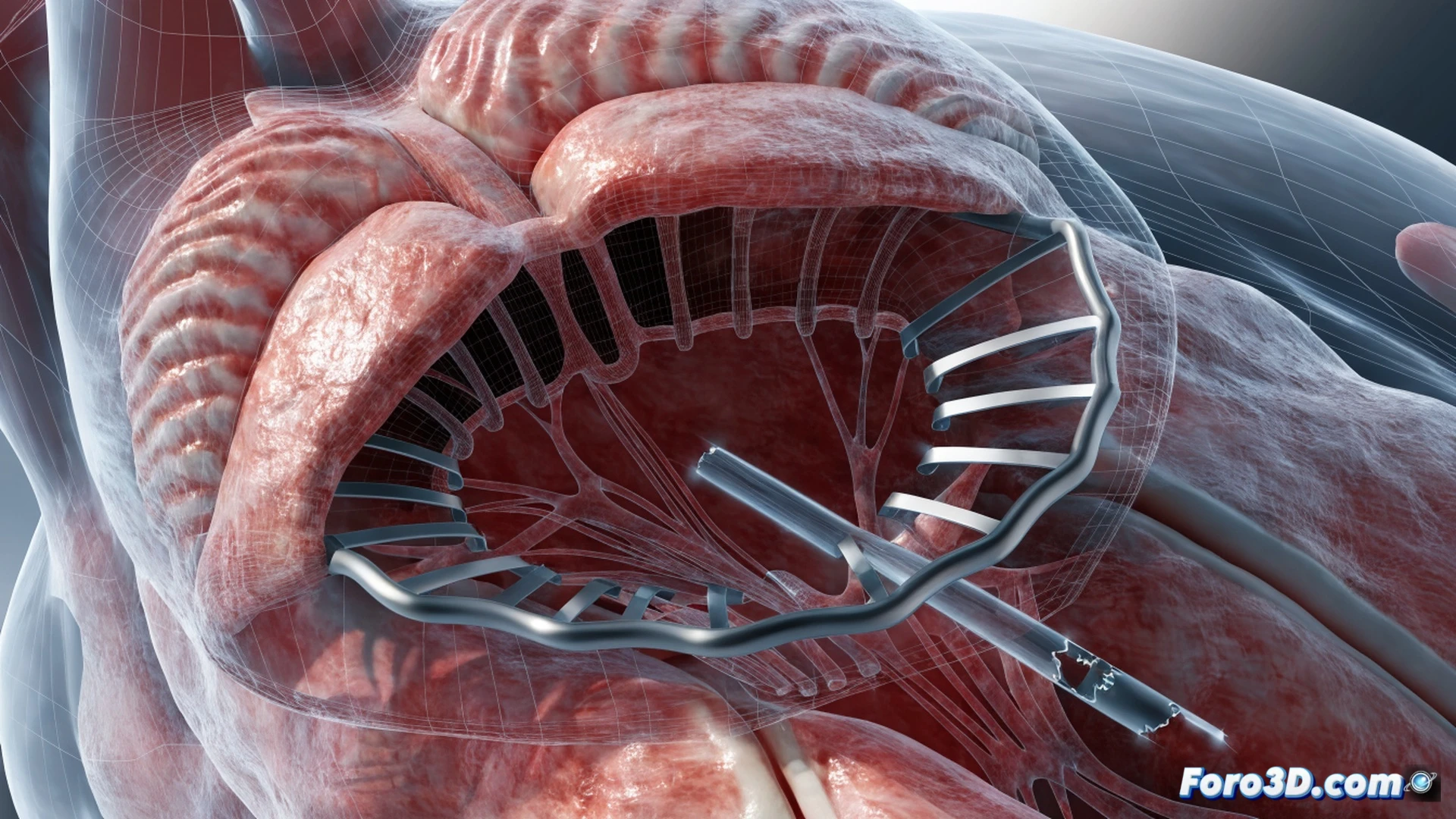 Fatiga de bajo ciclo en stent mitral por expansión incompleta