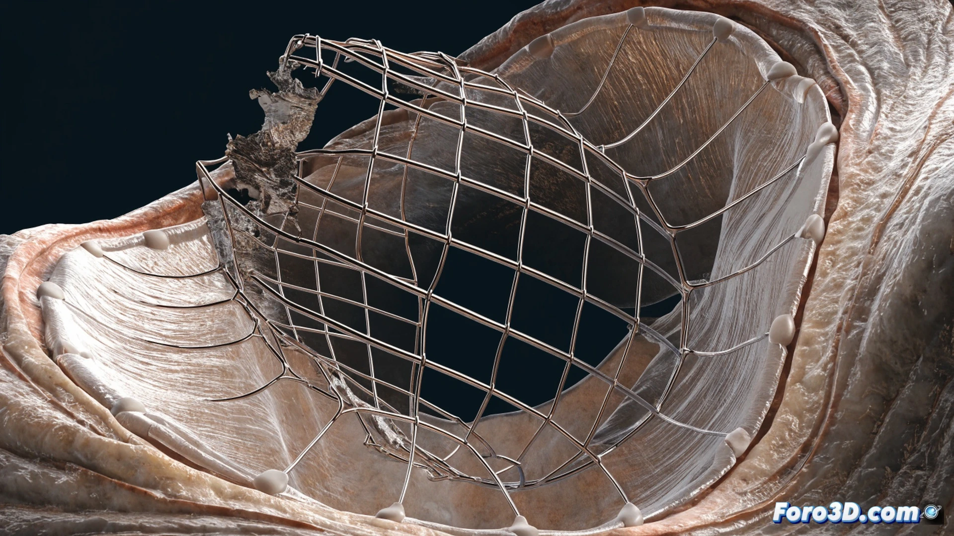 Nitinol valve stent undergoing asymmetric overexpansion fatigue failure, implant strut fracturing under uneven cyclic load, one side of the scaffold bulging outward while the opposite side shows crack propagation, metallic lattice structure deforming with stress concentration zones, computational simulation interface in background displaying stress maps and cyclic load curves, cinematic engineering visualization, polished metal surfaces with visible grain texture, dramatic side lighting emphasizing fracture edges, photorealistic technical illustration