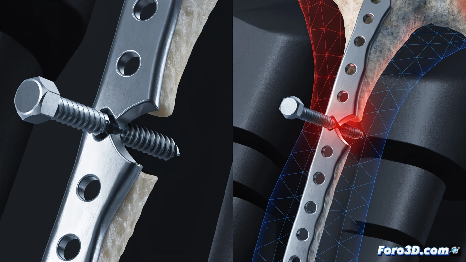 clavicle bone plate implant during cyclic loading fatigue fracture, screw notch acting as stress concentration point initiating microscopic crack, 3D Slicer segmentation model interface visible on monitor in background, Abaqus simulation showing red-hot stress contours around screw hole, metallic plate bending under repeated mechanical load, fractured screw head separating from shaft, engineering visualization style, photorealistic metallic surfaces, crack propagation lines glowing orange, dramatic side lighting on surgical hardware, detailed thread geometry, technical illustration