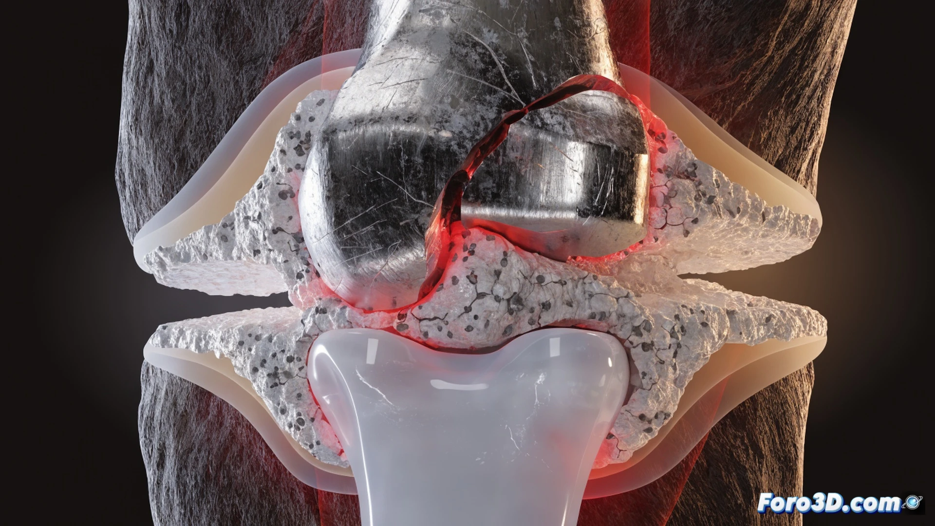 Fractura y aflojamiento en prótesis unicompartimental de rodilla