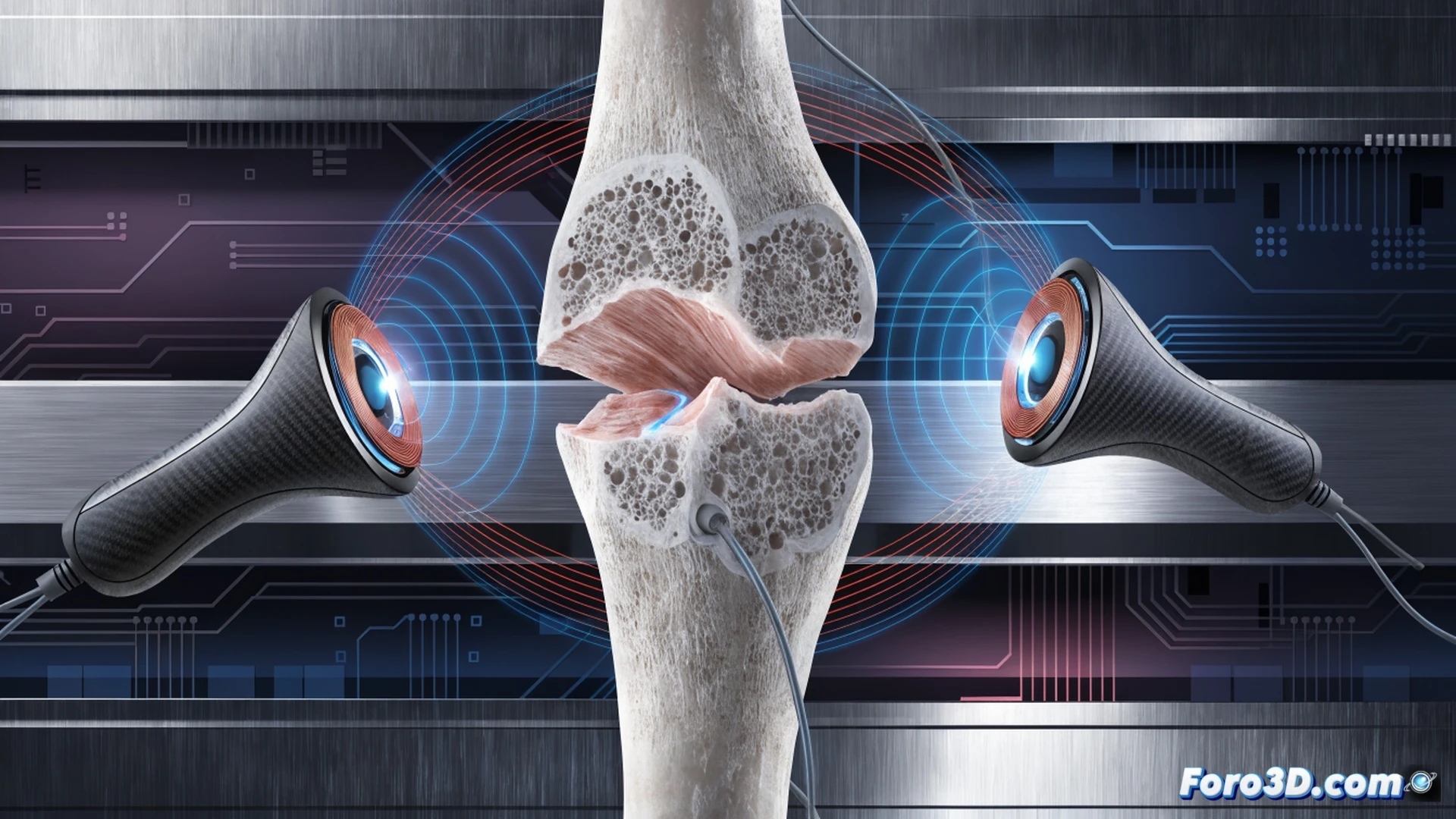 portable magnetotherapy device emitting pulsed electromagnetic fields around a fractured human femur, bone regeneration process showing osteoblast activity at fracture site, patient wearing lightweight external device on forearm, transparent anatomical overlay revealing bone healing action, clinical setting with medical monitoring screen displaying field frequency waves, photorealistic medical engineering visualization, soft blue and white lighting, high-contrast detail on bone microstructure, realistic tissue translucency, cinematic technical illustration