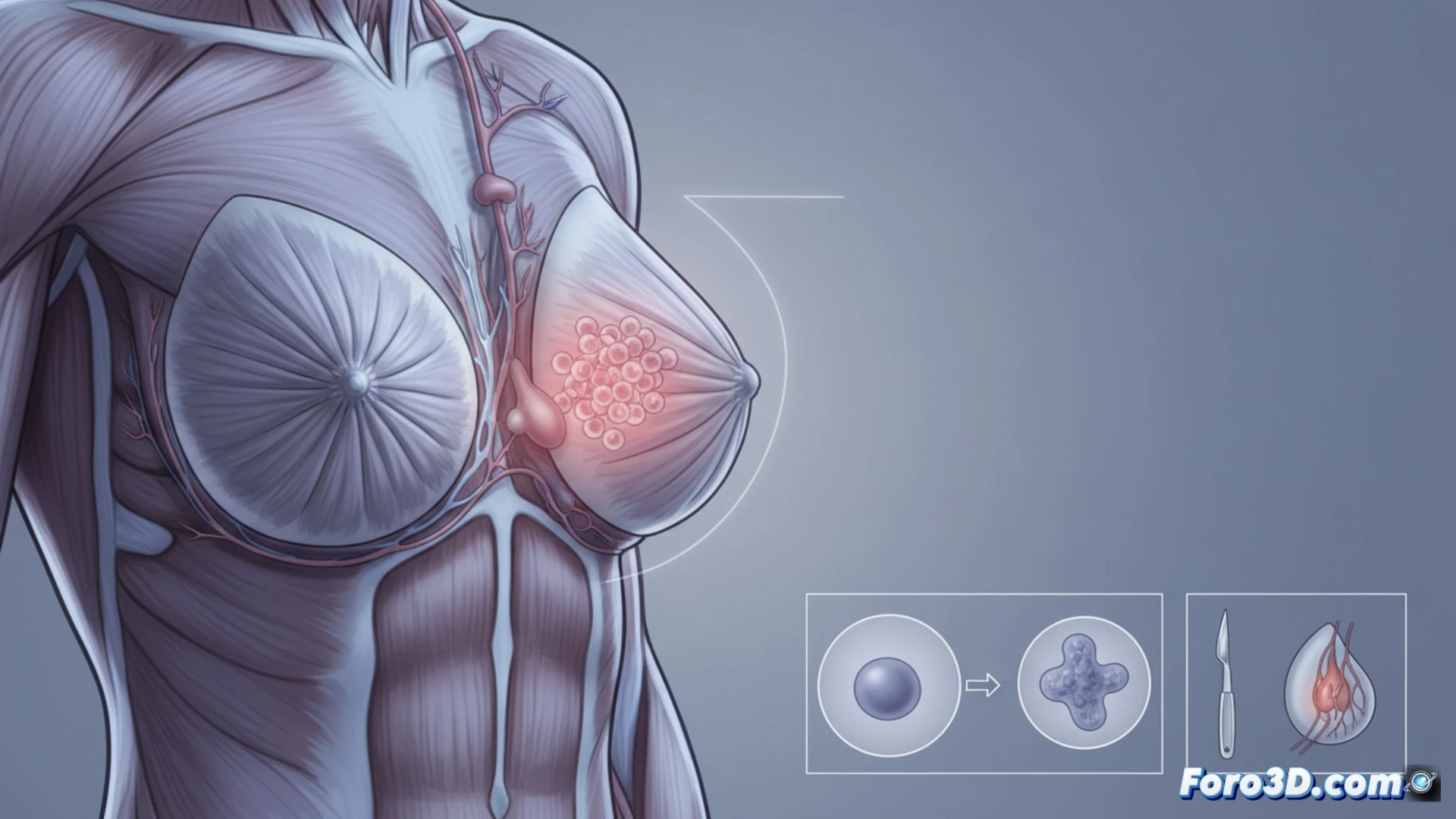 medical illustration showing a surgeon examining a textured breast implant under bright surgical light, cross-section diagram of implant capsule with abnormal cell growth indicated by glowing orange dots, anatomical diagram of lymphatic system in chest area, patient hand touching swollen breast tissue while looking at medical chart, technical medical visualization style, photorealistic anatomical details, soft clinical lighting, sterile hospital environment, precise surgical instruments on tray, educational medical diagram aesthetic