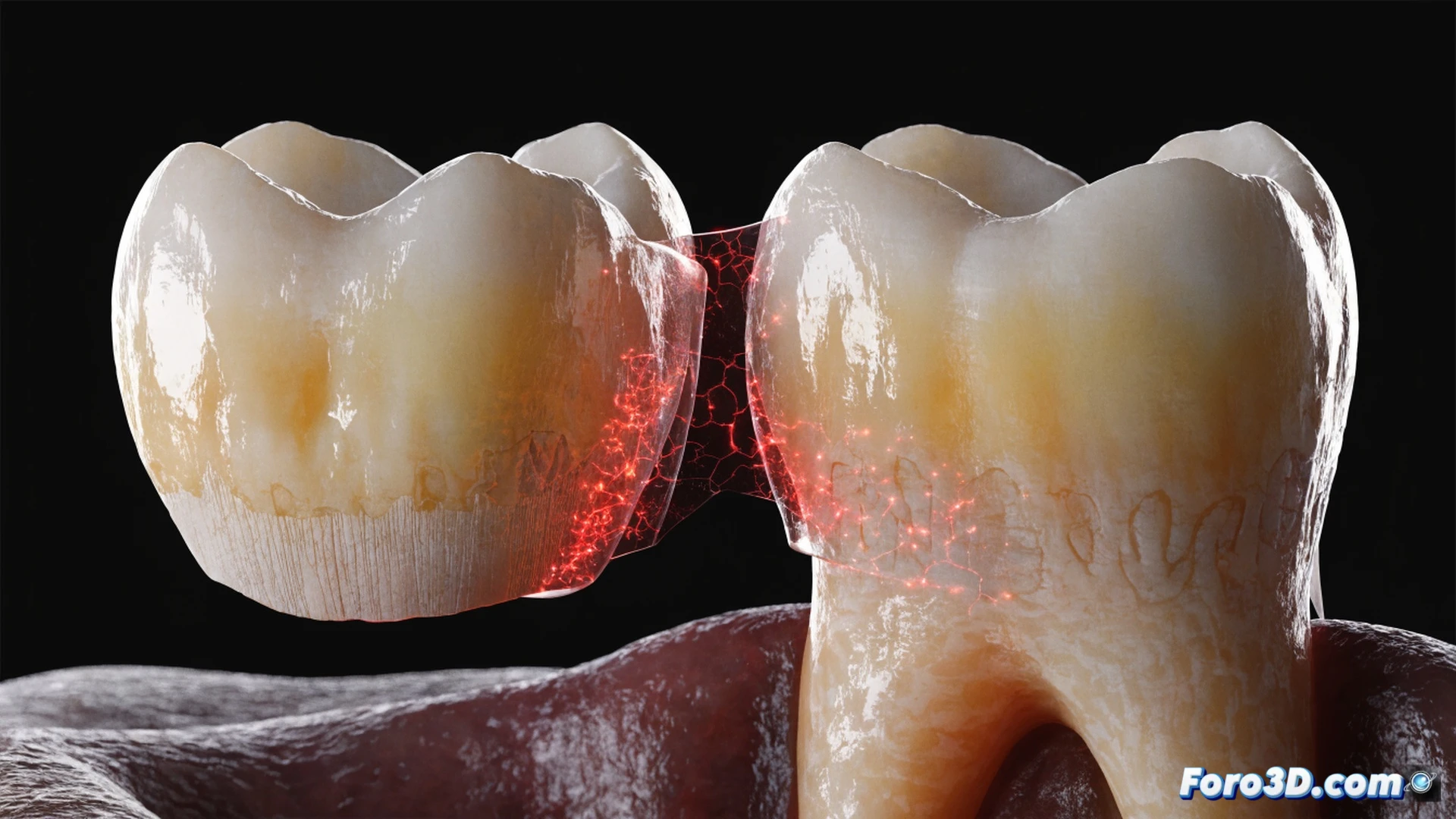 3D Slicer segmentation of a molar crown and root geometry, volumetric shrinkage of resin cement creating micro-fractures along the tooth-cement interface, Abaqus simulation showing stress concentration lines radiating from the crown margin, photorealistic engineering visualization, semi-transparent crown revealing internal crack propagation, glowing red tensile stress hotspots, dental bur and cement syringe in foreground, clinical lighting with high contrast, detailed enamel and dentin layers visible, ultra-sharp macro focus on the adhesive gap