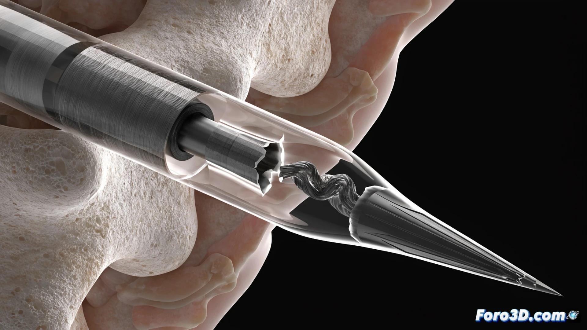 high magnification volumetric scan of a spinal needle showing internal fracture with latent metal extrusion, cross-sectional view revealing microscopic crack propagating through the needle wall, digital inspection interface displaying 3D reconstruction data, red highlighted defect area contrasting against silver metallic surface, technical engineering visualization style, cinematic lighting emphasizing structural failure, ultra-detailed mechanical texture, photorealistic industrial render, sharp focus on crack tip with surrounding metal grain structure visible