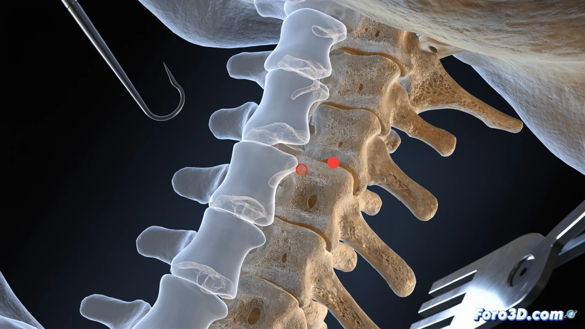 Surgical navigation screen showing 3D spine model with misaligned registration overlay, surgeon's hand holding tracked probe touching patient's vertebra while virtual tool tip drifts off bone, optical tracking camera array mounted on OR ceiling tracking reflective spheres on instruments, red warning indicator on monitor highlighting calibration error, MeshMixer interface visible on secondary display processing DICOM data, technical engineering visualization style, cinematic lighting with cold clinical tones, photorealistic medical illustration, sharp focus on misalignment gap between real and virtual anatomy