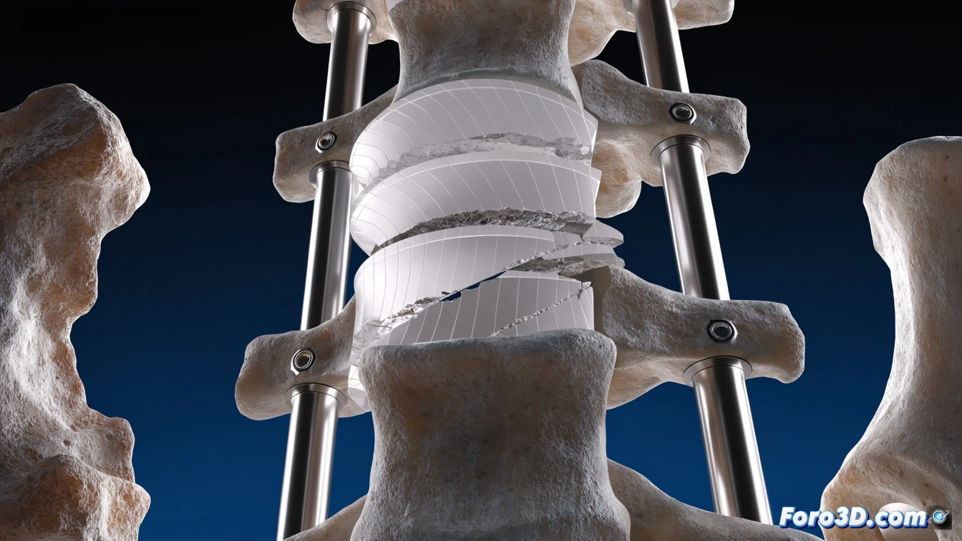 lumbar implant polymer fracture simulation, asymmetric wear surface showing cracks propagating through advanced polymer disc, 3D segmentation interface with Materialise Mimics visible as wireframe overlay, finite element analysis mesh in Abaqus displaying stress concentration in red-orange gradients, implant breaking under non-uniform load vectors, technical engineering visualization, polished titanium endplates contrasting with fractured polymer core, detailed crack branching along wear asymmetry lines, realistic material textures, dramatic side lighting emphasizing fracture surfaces, photorealistic medical device render