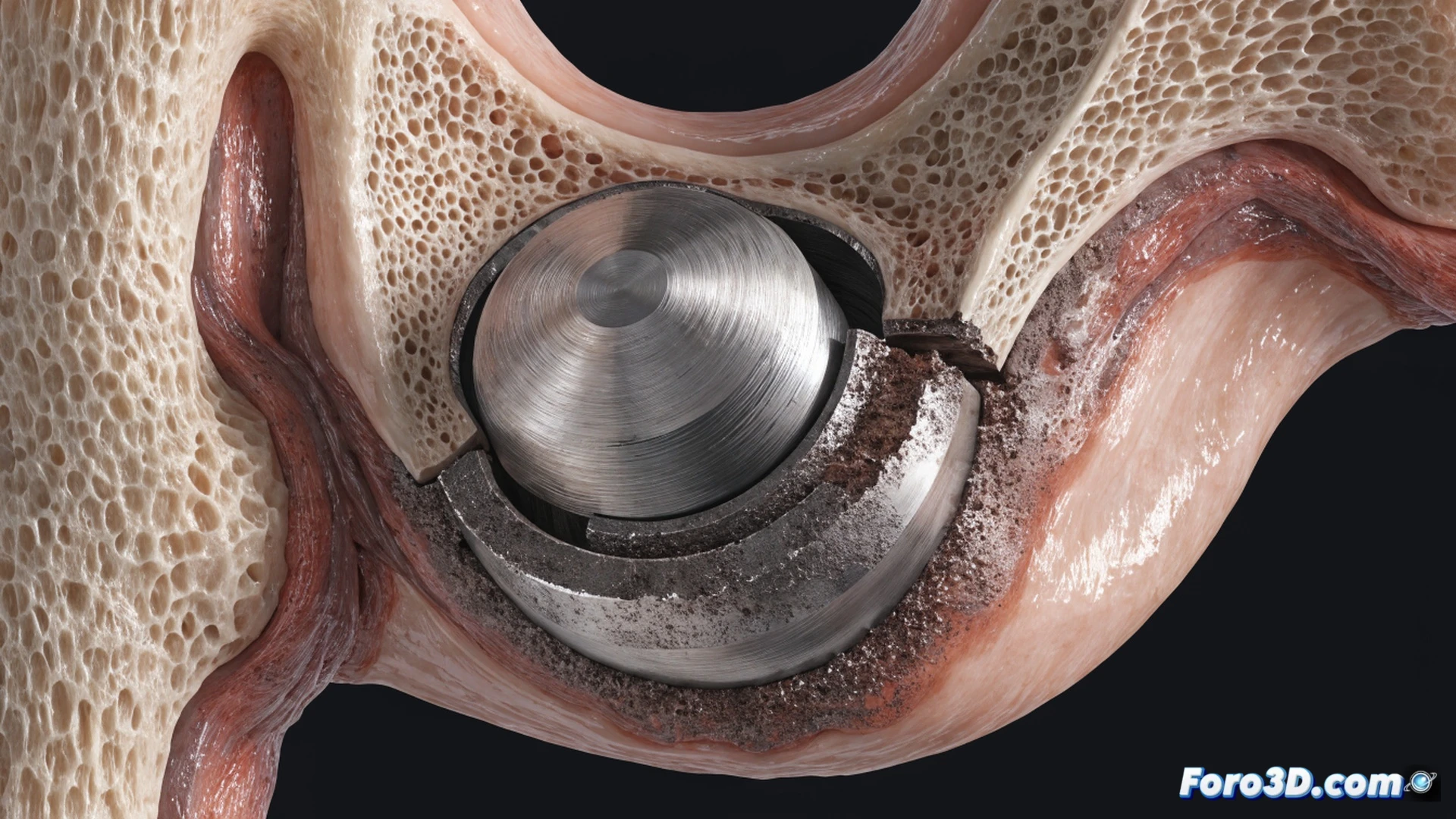 Prótesis de resurfacing de cadera fracturada sobre mesa de análisis forense, componente acetabular mostrando desgaste asimétrico con superficie metálica erosionada, partículas metálicas dispersas en tejido blando circundante durante inspección microscópica, ingeniero sosteniendo pinzas quirúrgicas mientras ilumina el implante con lupa de aumento, fondo con pantalla de software CAD mostrando modelo 3D del fallo, iluminación quirúrgica fría, texturas metálicas detalladas y desgaste por fricción visible, estilo photorealistic technical illustration