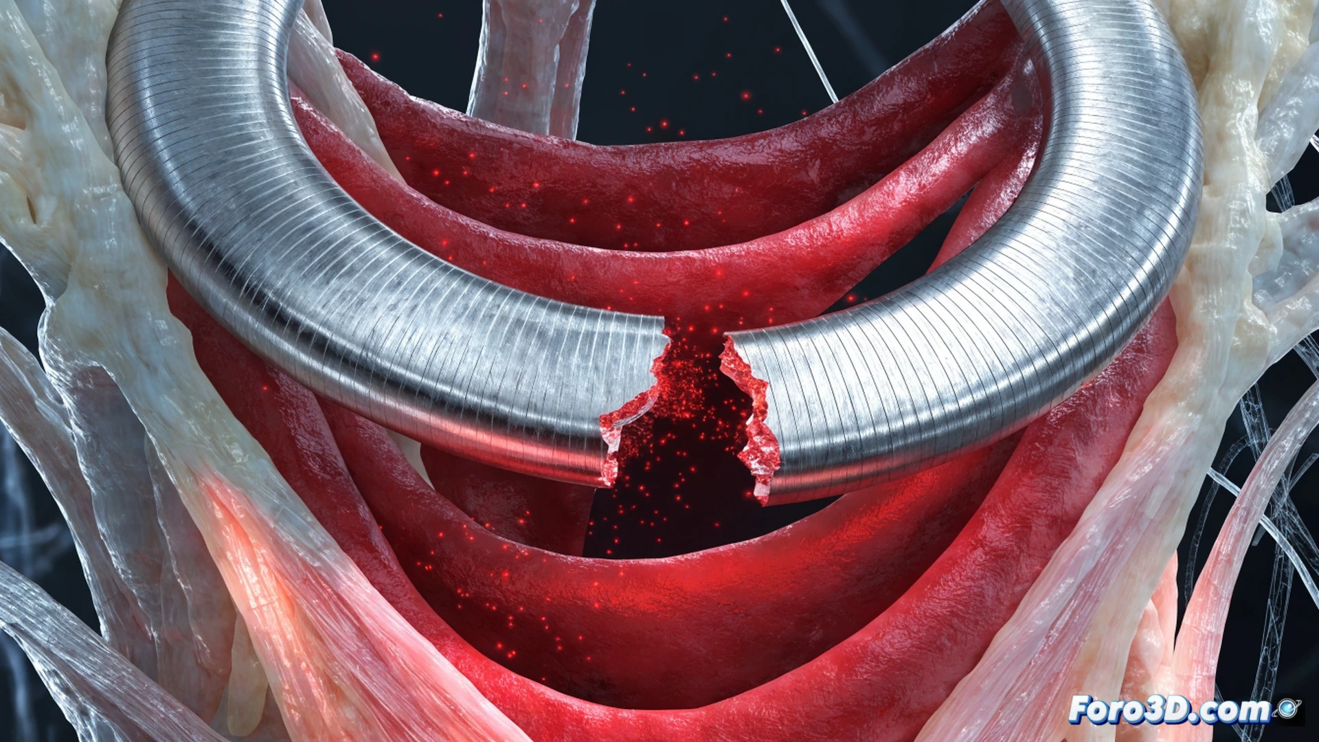Nitinol tricuspid annulus ring fracturing under cyclic stress, heart valve implant being deformed during surgical placement, finite element analysis simulation showing stress concentration zones in red on ring surface, pipeline workflow with Mimics segmentation mesh transitioning to Ansys solver interface, metallic nitinol crystal structure cracking at microscopic level, cinematic engineering visualization, dramatic side lighting on polished metal surface, realistic biomechanical render with glowing FEA heatmaps, detailed lattice deformation lines, photorealistic technical illustration