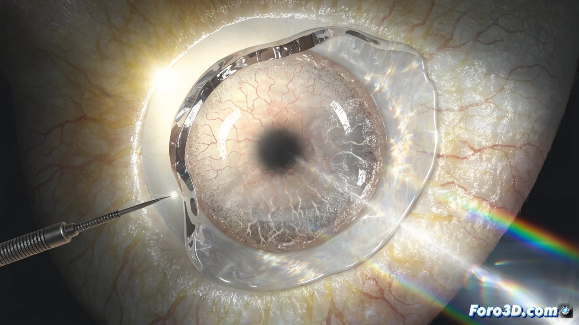 Queratocono corneal treatment, soft hydrogel implant being inserted into a deformed cornea during laser-assisted surgery, microscope and surgical laser equipment surrounding the eye, hydrogel material glowing slightly blue under operating light, cornea reshaping process visible, no text, photorealistic medical illustration, cinematic lighting, detailed surgical instruments, transparent hydrogel structure, realistic human eye anatomy, sterile operating room environment, technical visualization of the implant procedure