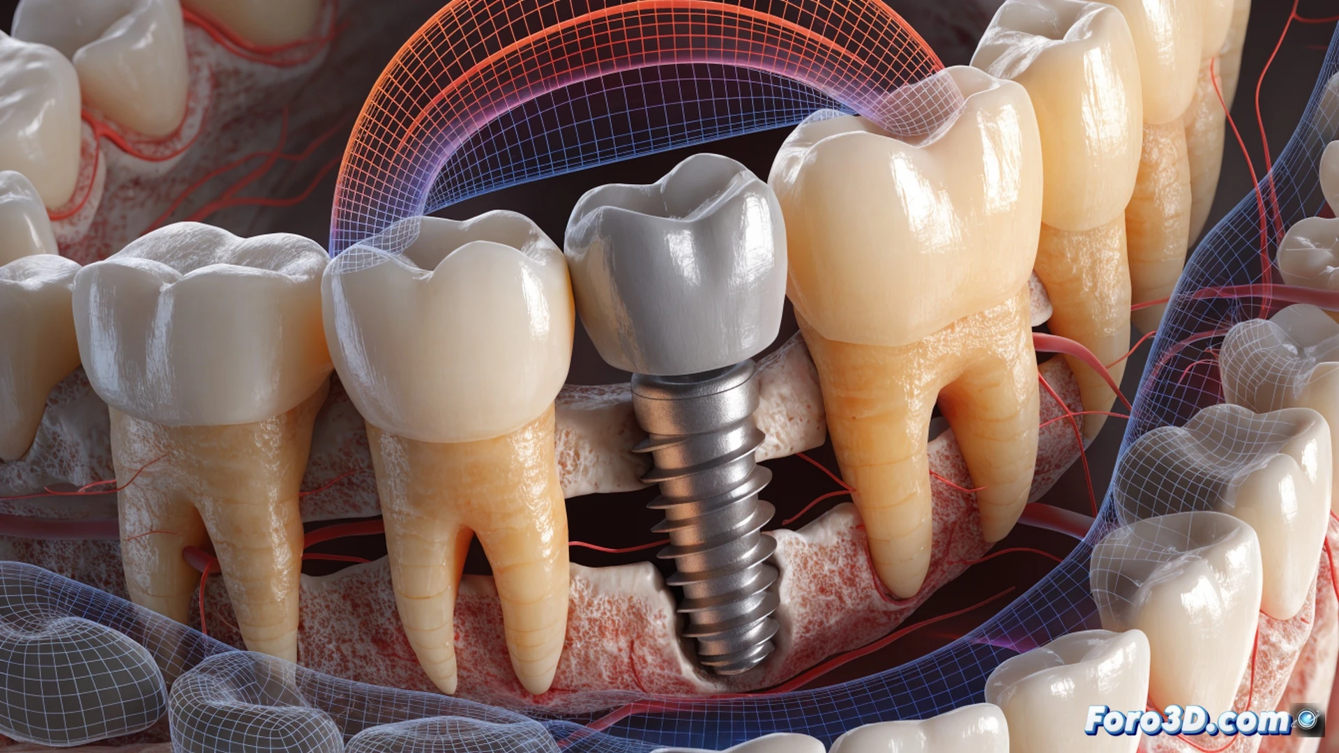 3D dental implant simulation showing micro-movement under occlusal stress, bone loss around titanium implant thread surface, jawbone section with cortical and trabecular layers, force vectors as glowing red arrows concentrated on implant crown, adjacent teeth showing normal bone integration for contrast, software interface elements from 3D Slicer and Abaqus visible as semi-transparent overlays, engineering visualization style, cinematic lighting from above, photorealistic medical render, detailed anatomical textures, stress distribution color map transitioning from green to red around failing implant