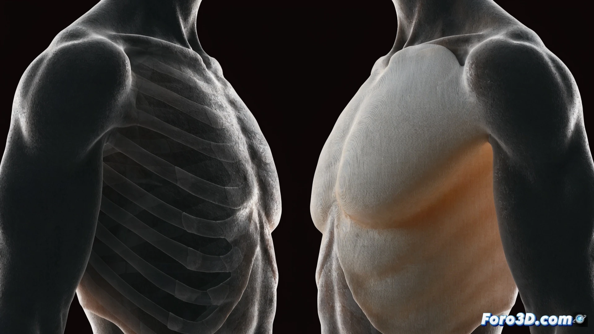 Pectus excavatum correction procedure, surgeon placing a custom translucent 3D-printed titanium implant into a patient s exposed chest cavity, implant perfectly conforming to the sternum anatomy, surgical tools and digital tablet showing patient-specific CT scan model on screen, bright operating room lights reflecting on polished metal instruments, photorealistic medical illustration, shallow depth of field focusing on the implant insertion point, soft dramatic shadows, hyper-detailed tissue textures and implant lattice structure, sterile clinical environment
