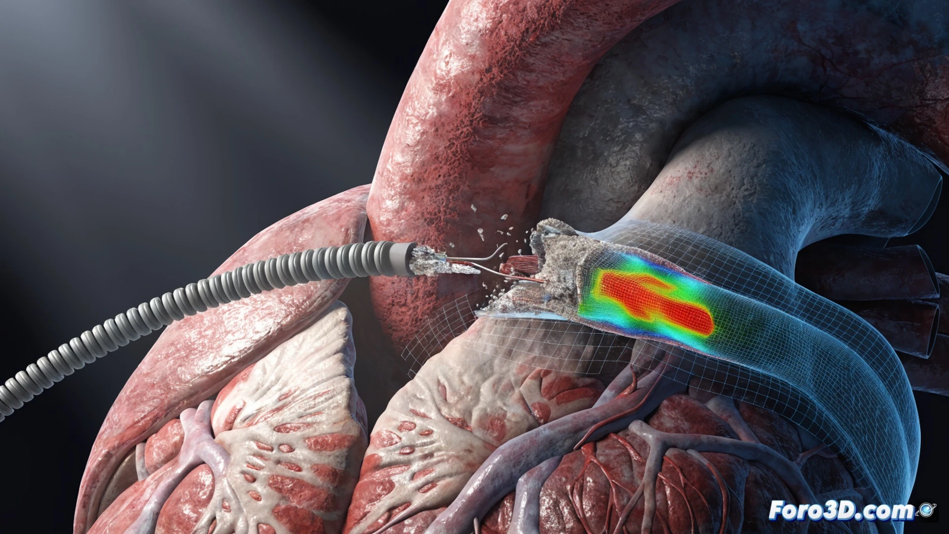 Imagen técnica fotorrealista de un cable conductor intracardíaco fracturándose dentro de una aurícula, mostrando la grieta por fatiga en el electrodo durante el ciclo de estrés mecánico, mientras el corazón late de fondo con líneas de tensión visibles. En primer plano, una pantalla de software Ansys simula las tensiones cíclicas con mapas de colores rojo y naranja sobre el cable, y al lado un monitor con Materialise Mimics muestra la segmentación 3D del tórax. Iluminación dramática azul quirúrgica, estilo cinematic engineering visualization, superficies metálicas pulidas, textura de tejido cardíaco realista, representación técnica ultra detallada.