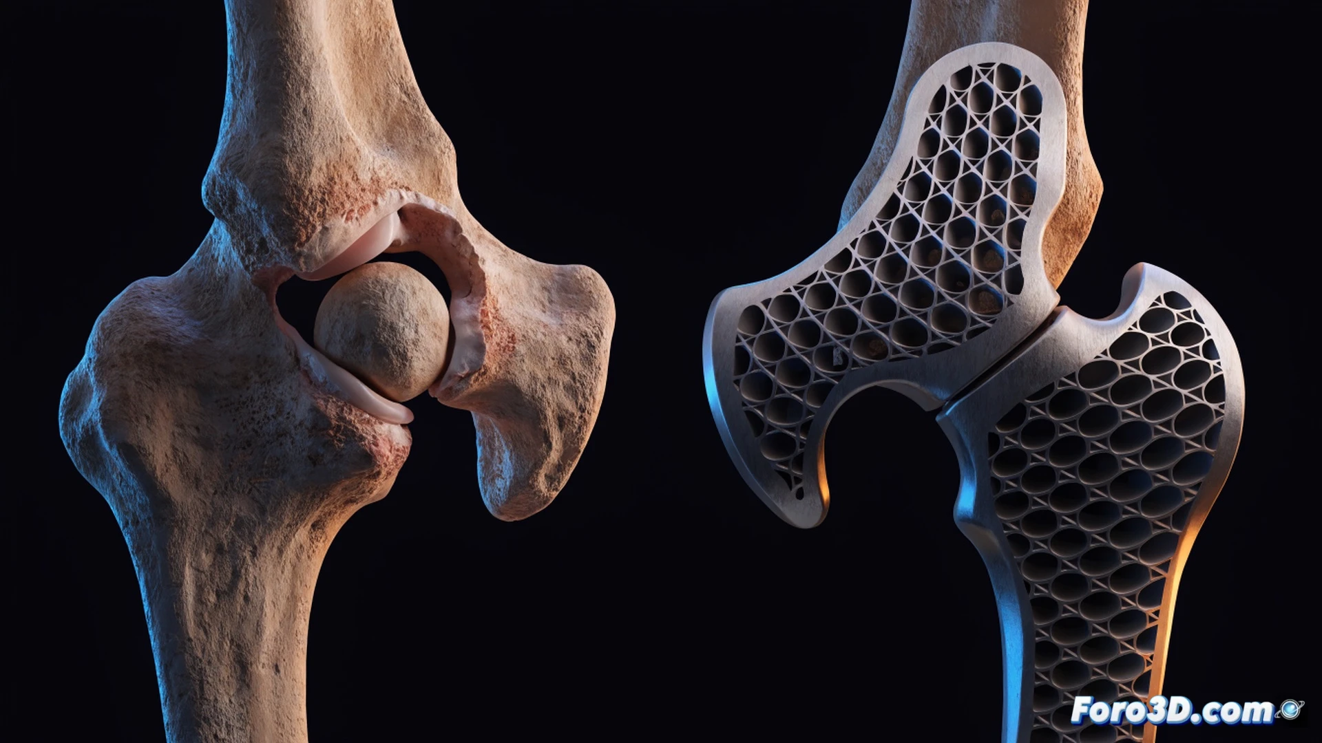surgical team positioning a custom 3D-printed titanium Shelf implant onto a patient exposed hip joint during minimally invasive arthroscopic surgery, implant surface showing porous lattice structure for bone integration, surrounding soft tissue retracted, arthroscopic camera and surgical tools visible, operating room monitors displaying real-time CT-based 3D bone model with implant placement overlay, dramatic overhead surgical lighting, sterile blue drapes, photorealistic medical visualization, cinematic depth of field, precise technical detail, ultra-realistic metallic and organic textures