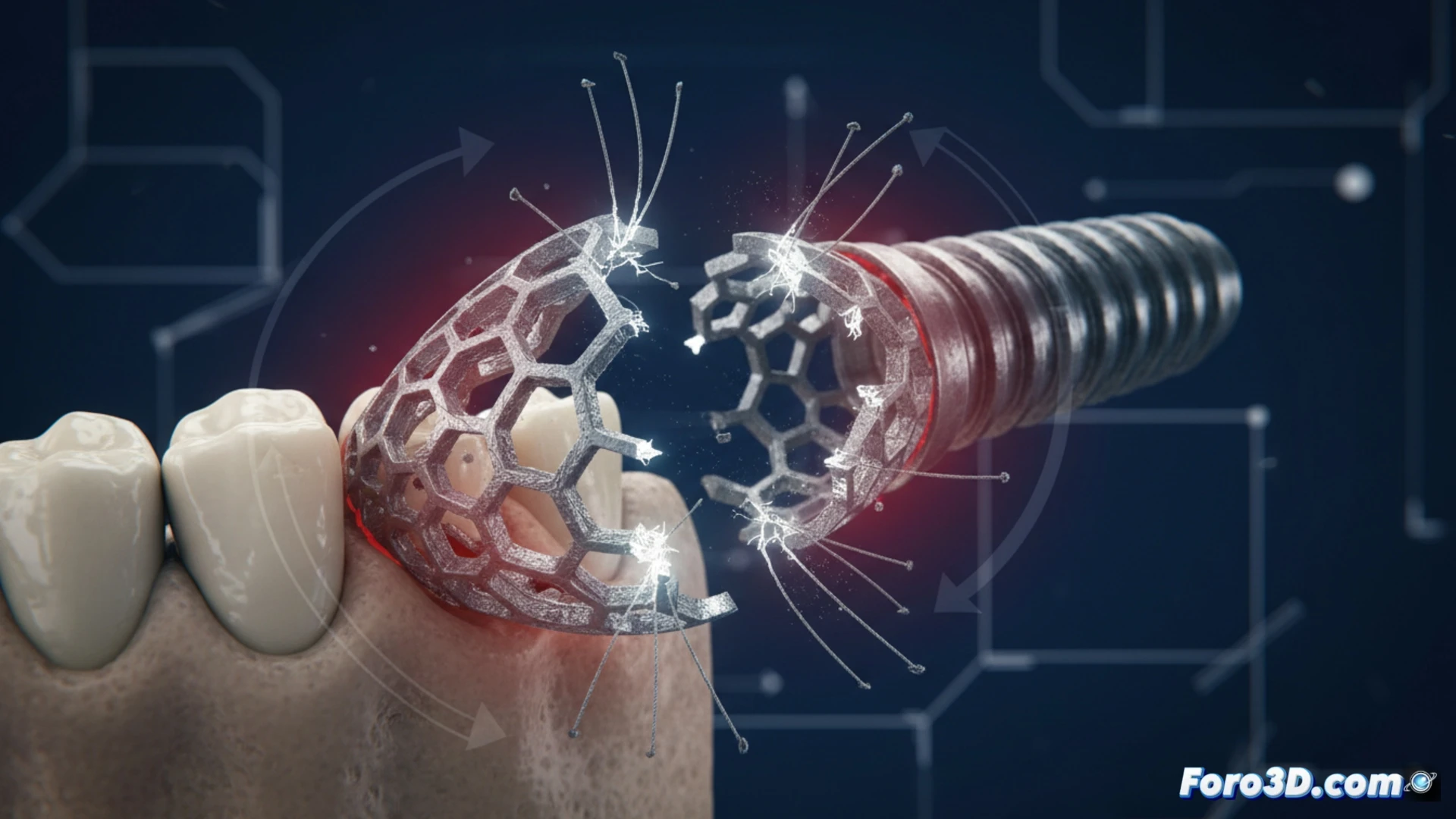 Fractura por fatiga en implante mandibular de titanio impreso en 3D con estructura reticular colapsada