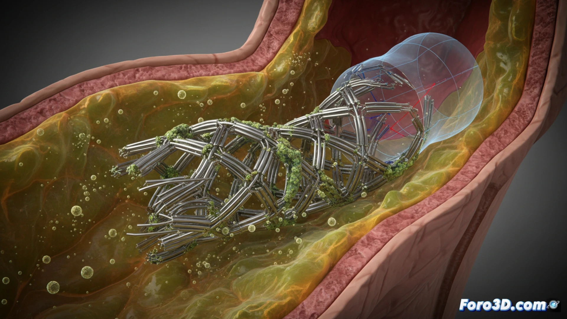 Micro-CT de stent traqueal de nitinol fracturado por corrosión galvánica en moco pulmonar ácido