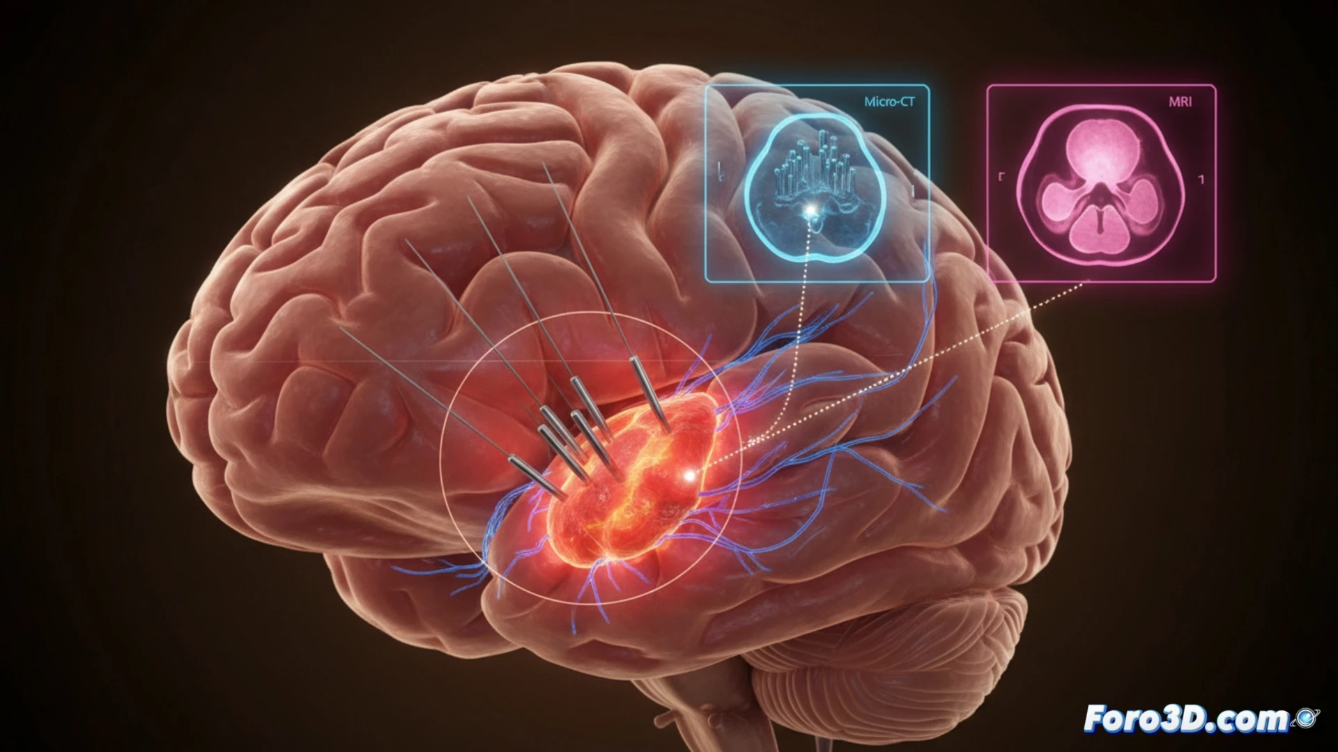 Imagen 3D de microelectrodos BCI migrando en tejido cerebral por inflamación, con datos de micro-CT y resonancia magnética superpuestos