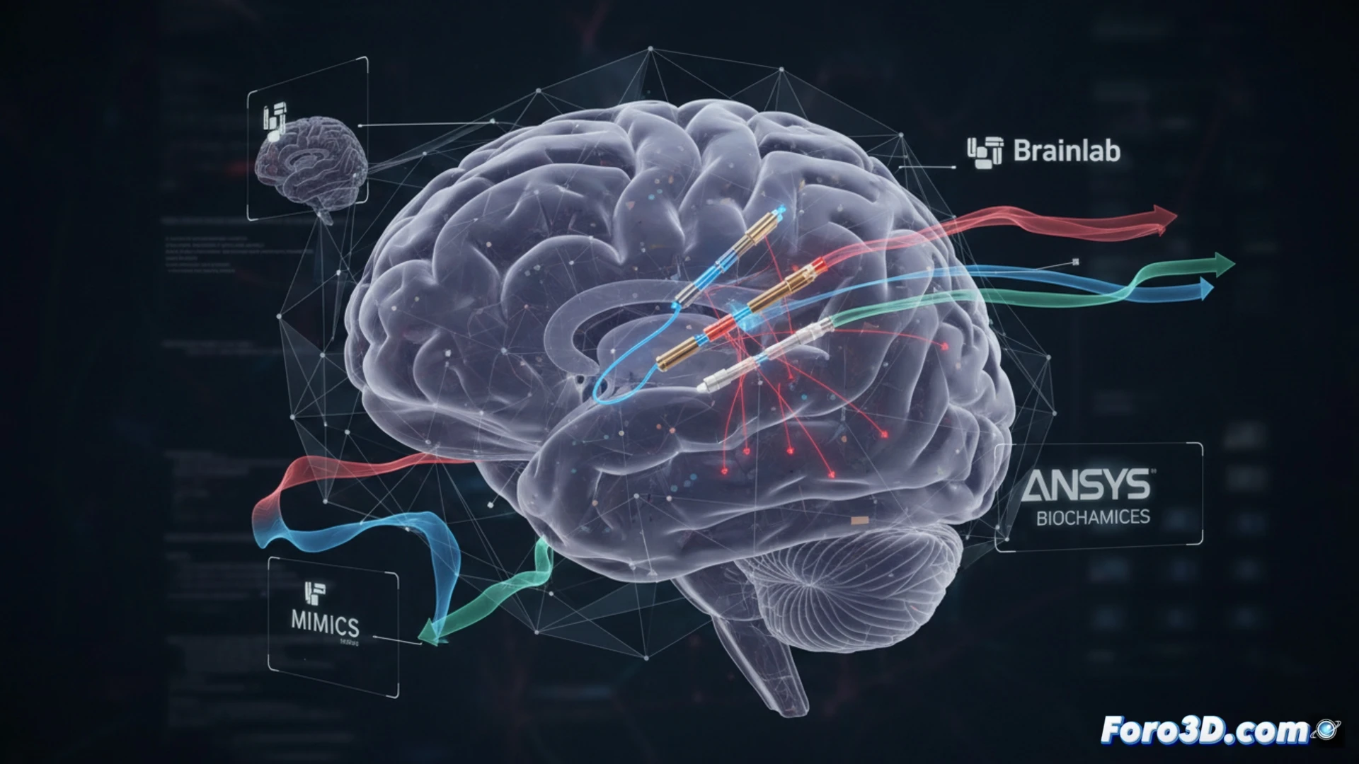 Simulación 3D de migración de electrodos en implante cerebral profundo para Parkinson