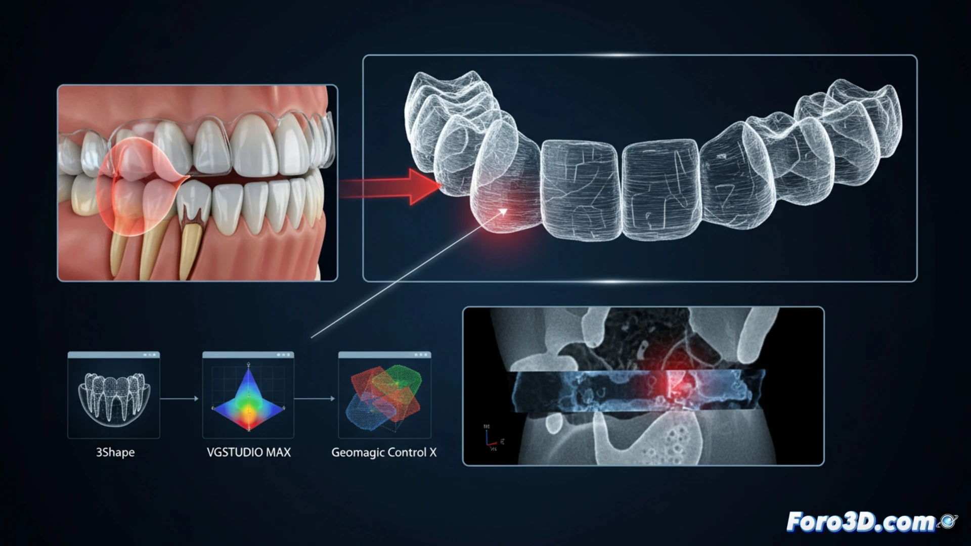 Micro-CT de alineador dental revela fuerzas de torsión ocultas que causan reabsorción radicular severa en incisivo lateral