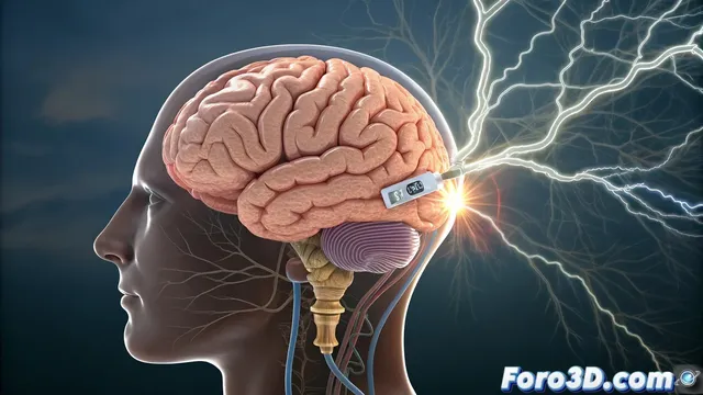 Implante cerebral personalizado con modelado 3D para alivio de dolor cronico