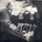 Clic en la imagen para ver su versión completa. 

Nombre: Xray5yrboy.jpg 
Visitas: 500 
Tamaño: 39.5 KB 
ID: 166188
